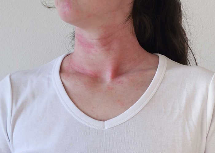 Dermatitis-atopica Dermatitis-atopica