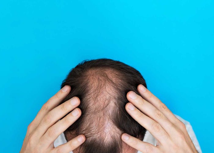 Diagnóstico-y-tratamiento-de-alopecia