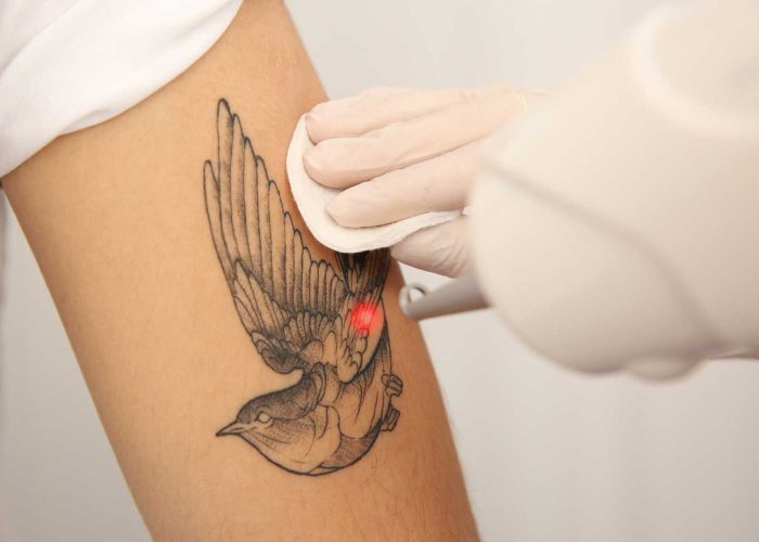 Láser-para-retiro-de-tatuajes Láser-para-retiro-de-tatuajes