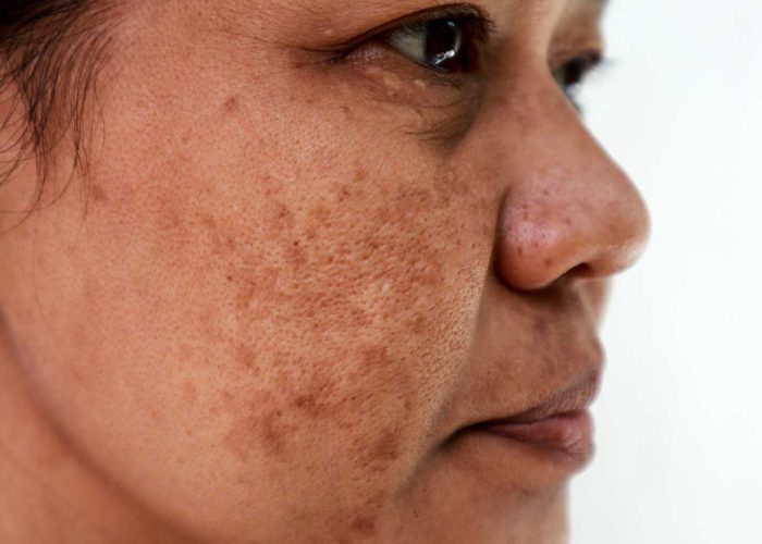 Melasma Melasma