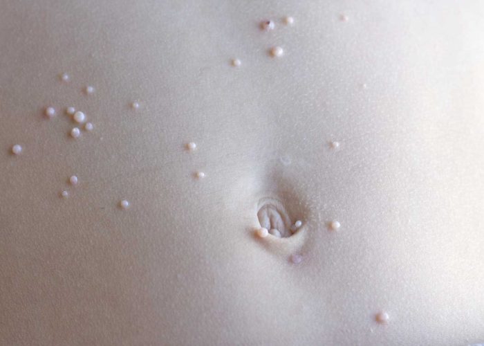 Molusco-contagioso Molusco-contagioso