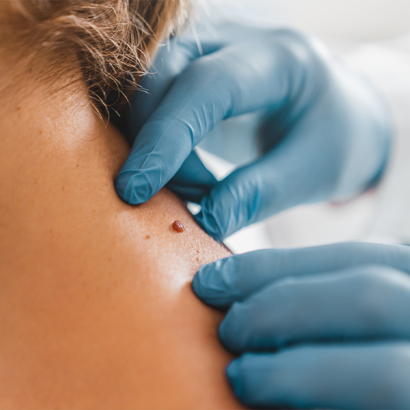 PELZ Derma Clinic Biopsia de Lunar_2 PELZ Derma Clinic Biopsia de Lunar_2