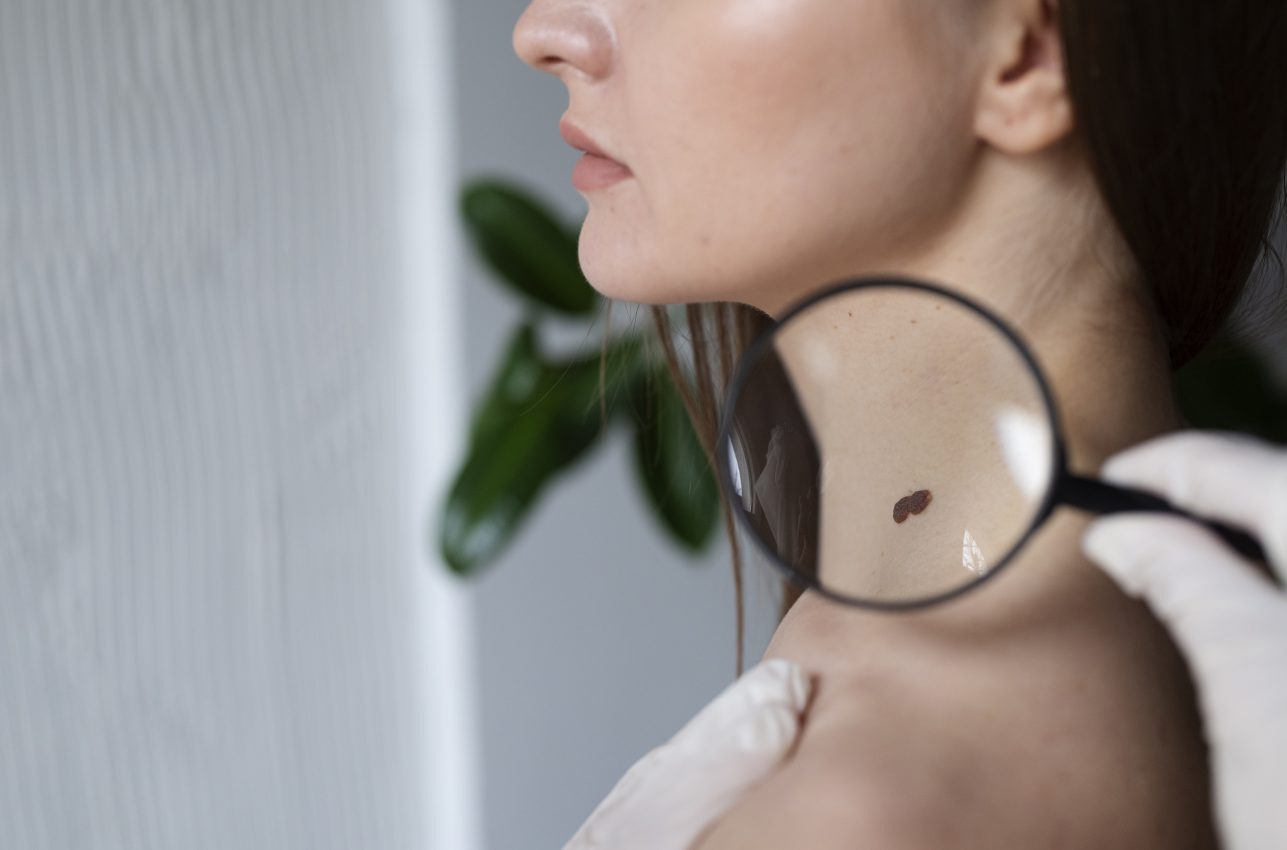 PELZ Derma Clinic Revision de Lunares Peligrosos